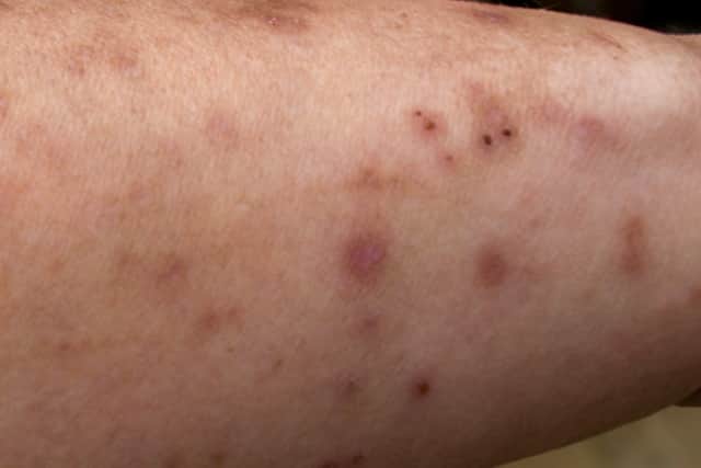Black spots on skin - bed bug bites scarring