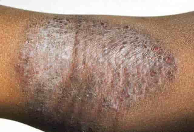 Black spots on skin - eczema