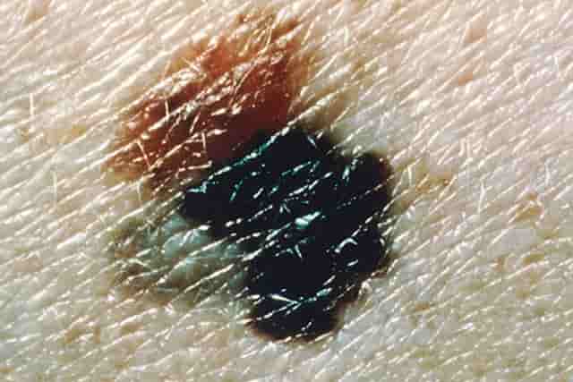Black spots on skin - melanoma