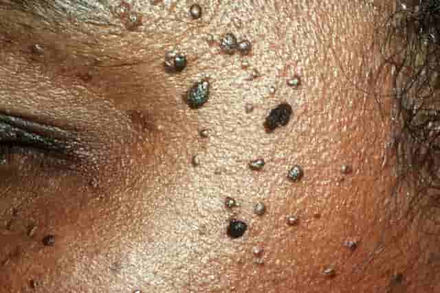 Black tiny dots on skin - dermatosis papulosa nigra (DPN)