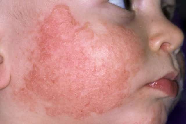 Dry patches on face - eczema