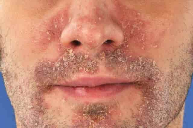 Psoriasis Skin Rash On Face