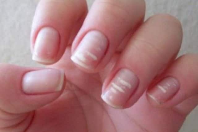 White spots on fingernails may be an indication of nutrient deficiency such as protein, keratin, zinc, calcium and vitamins