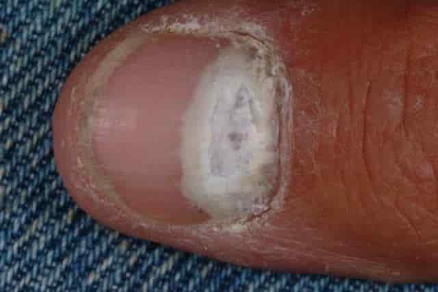 White spots on fingernails may be lie on the nail bed