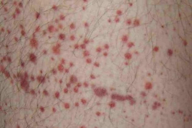 Purple spots on skin - purpura rash